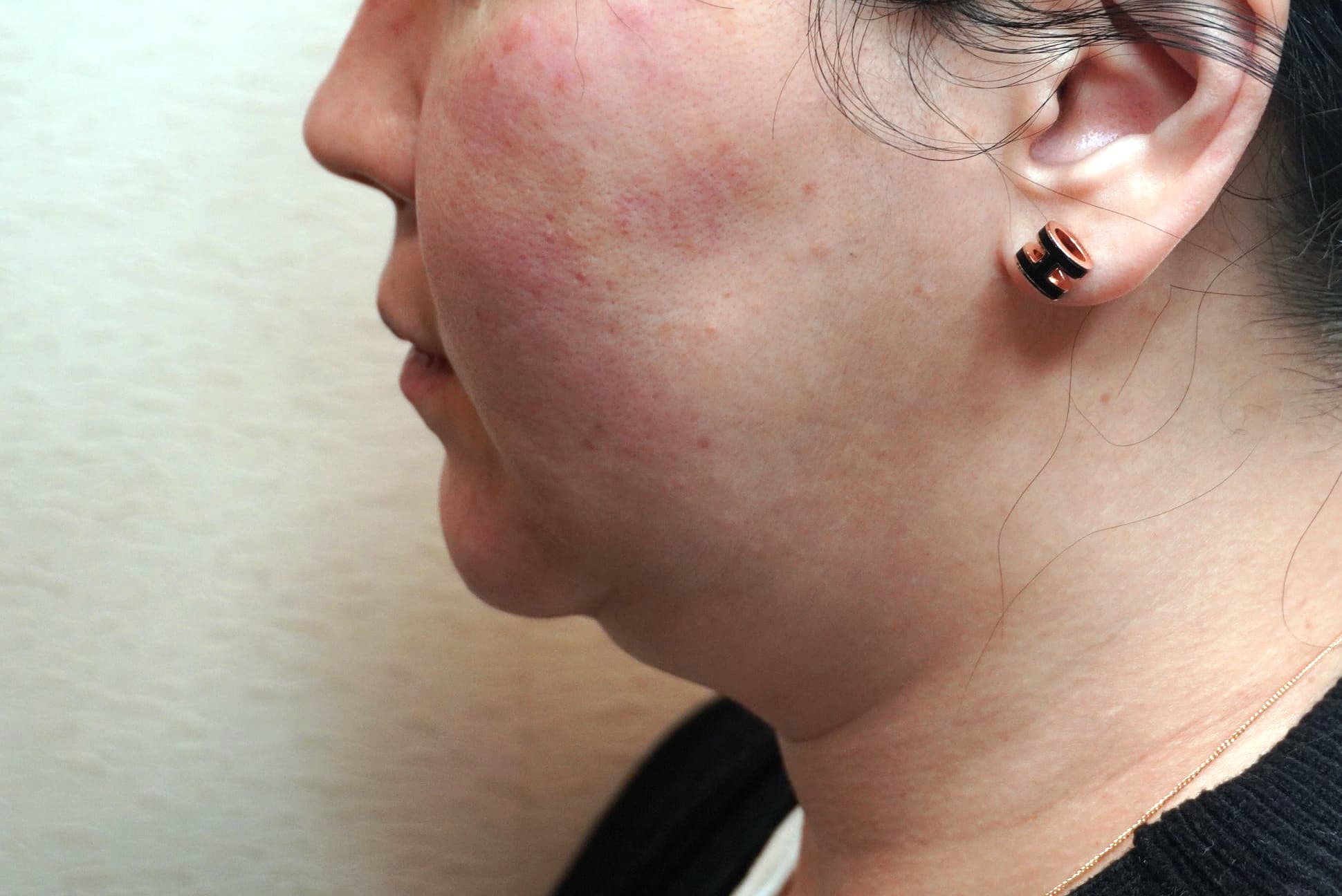 二重あごに脂肪溶解注射が効かないと感じたら、ブイオレット(V-OLET)の受け方