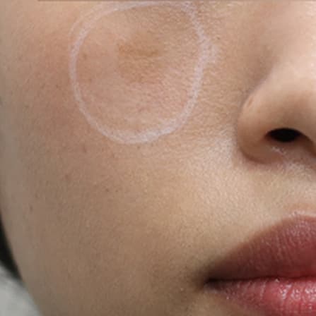 日光黒子(シミ)除去レーザーの費用と回数|リポットレーザーでなくても