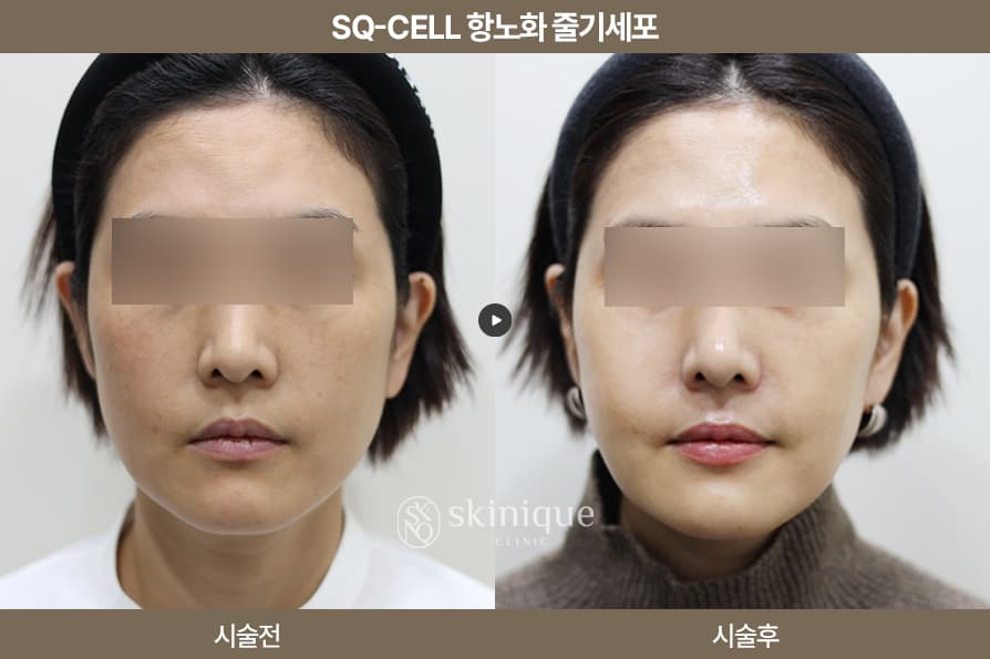 SQ Cell Stem Cell - Anti-Aging