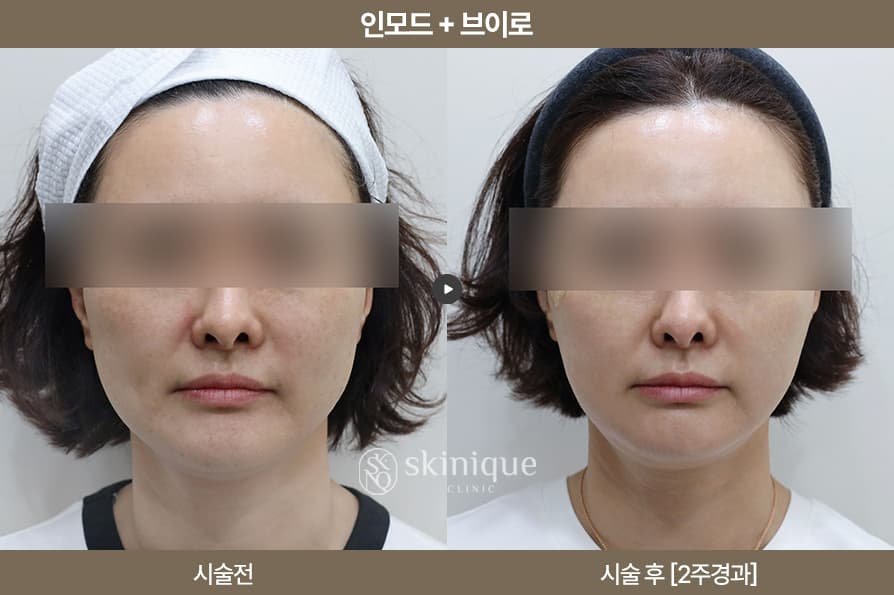 InMode + V-RO - Contour & Tone Improvement