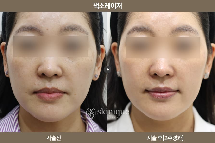 Pigmentation/Regeneration - Pigment Laser 2 Weeks