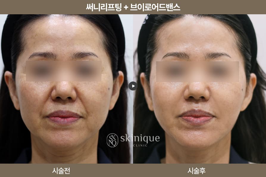 Sunny Lifting - V-RO Dual