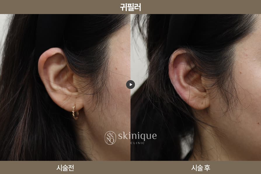 Ear Filler - Case 5