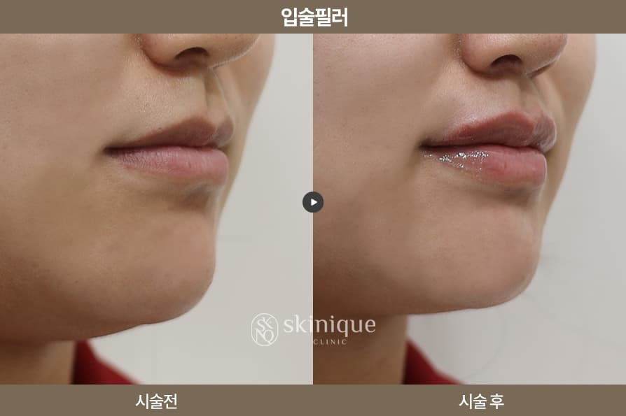 Filler - Lips (China) 2