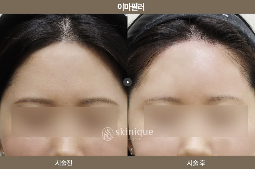 Filler - Forehead 1