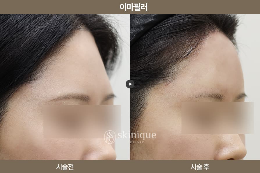 Filler - Forehead 2