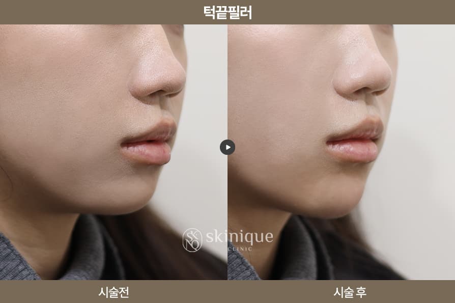 Filler - Chin Tip 45 Degrees