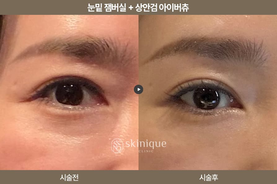 Jamber Sil - Under Eyes + Eye Virtu