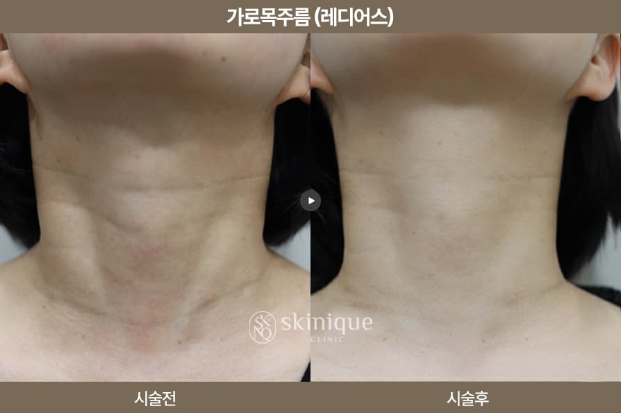 Radiesse - Horizontal Neck Wrinkles