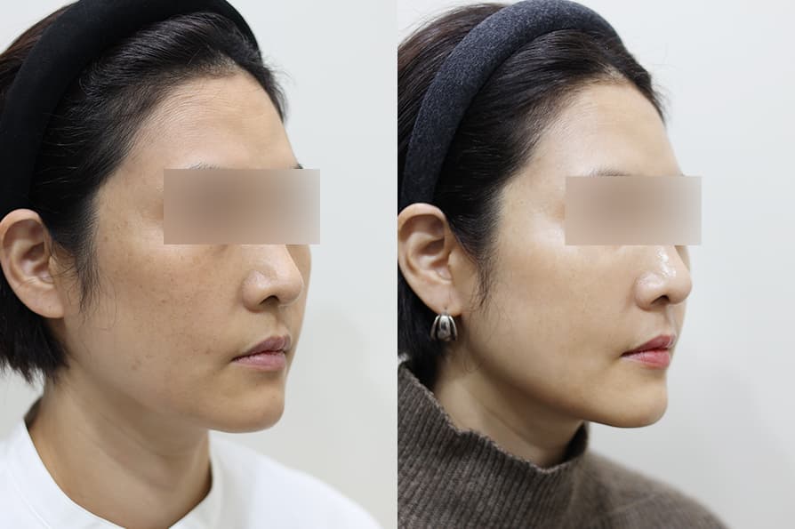 SQ Cell Stem Cell - Tone & Texture Improvement