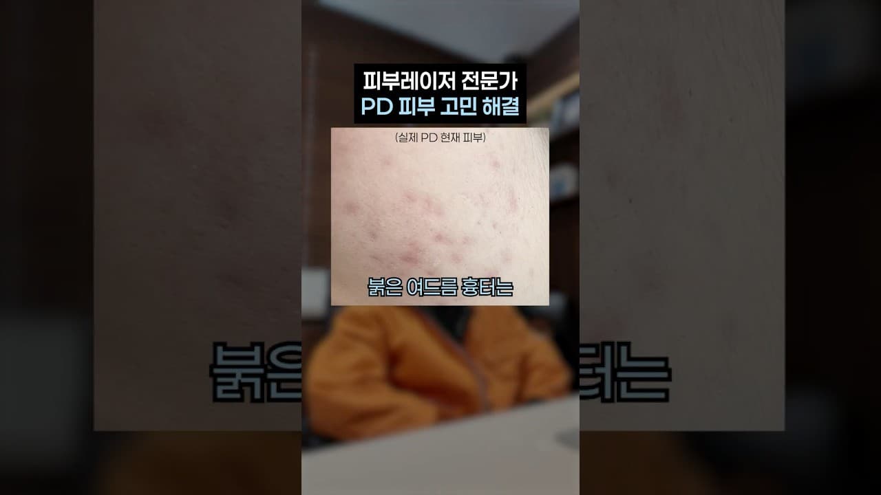 赤いニキビ跡、パク・テヒョン院長が勧める治療法は?